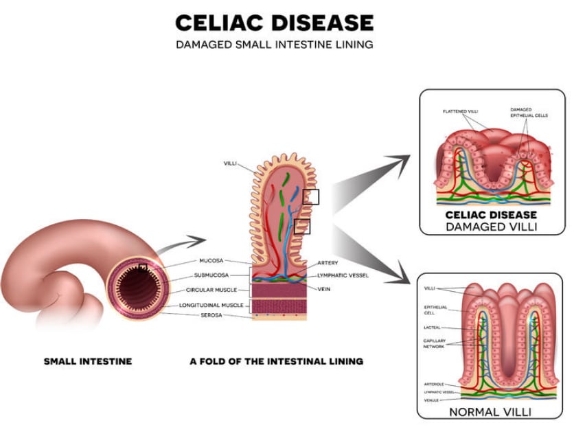 objawy celiakii
