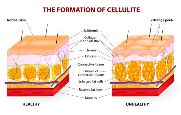 Cellulit – domowe sposoby i zabiegi lecznicze